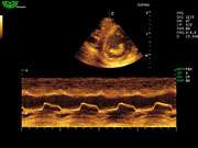 Regurgitation of Tricuspid,